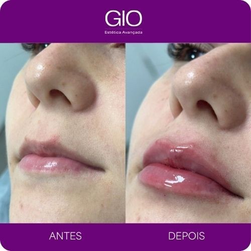 Preenchimento Labial