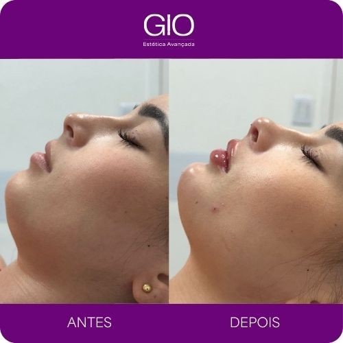 Harmonização facial