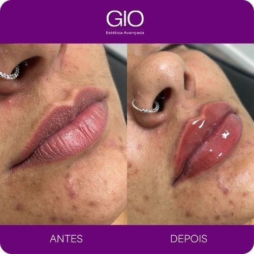 Preenchimento labial