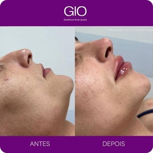 Harmonização facial