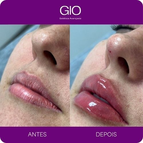 Preenchimento labial