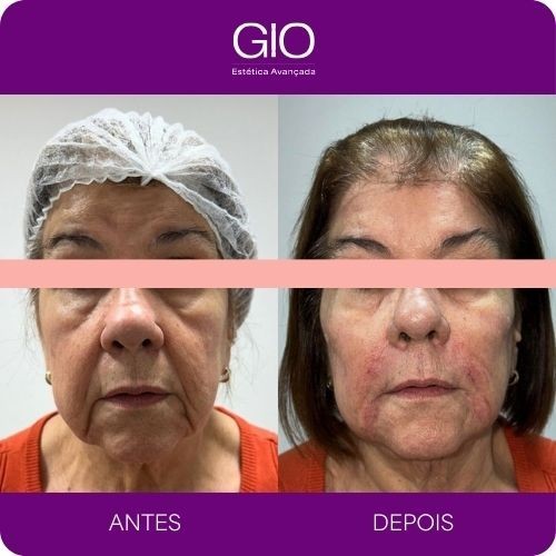 Preeenchimento bigode chinês e Toxina Botulínica